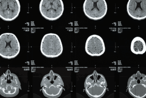 Image is of an MRI scan sheet, concept of brain injuries after an accident in Aiken