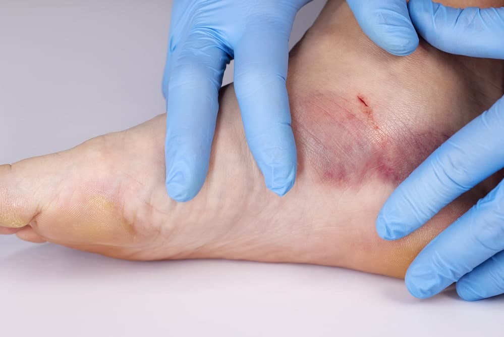 Image is of a medical professional examining a dog bite injury on a person's ankle, concept of a dog bite lawyer helping victims recover medical expenses.
